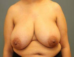 BREAST REDUCTION: Case 49 Before